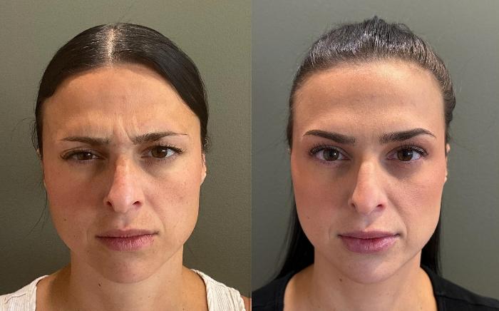 Before & After BOTOX® Cosmetic & Dysport® Case 454 Front View in Ann Arbor, MI