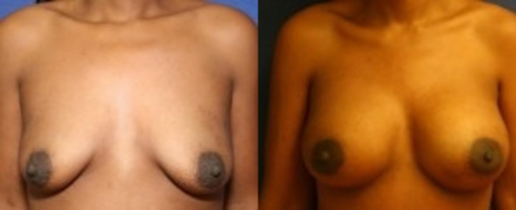 Before & After Breast Augmentation Case 10 Front View in Ann Arbor, MI