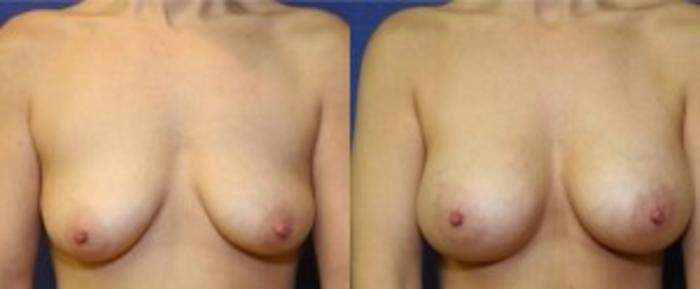 Before & After Breast Augmentation Case 11 Front View in Ann Arbor, MI