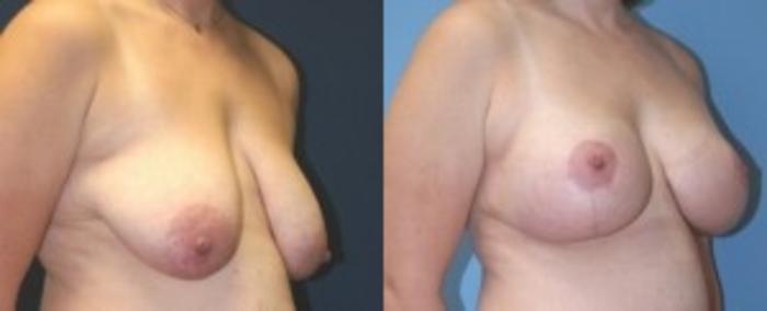 Before & After Breast Augmentation Case 12 Right Oblique View in Ann Arbor, MI