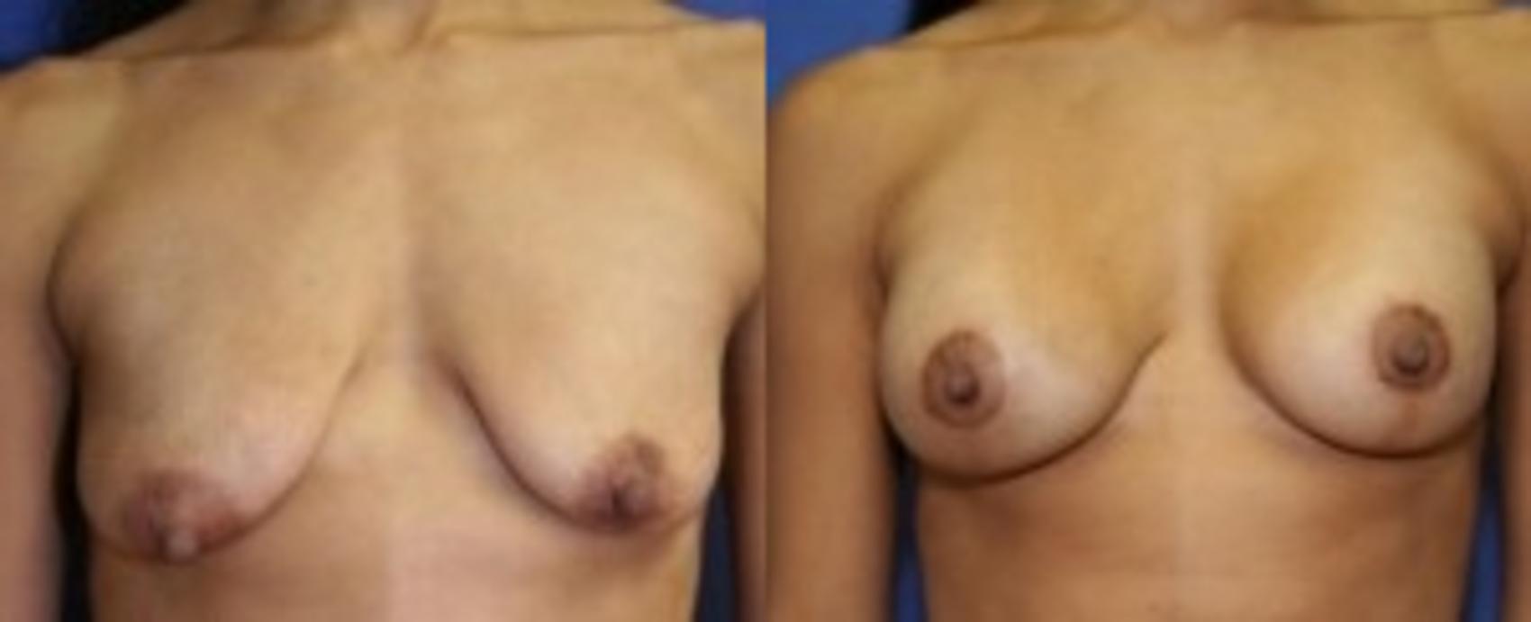 Before & After Breast Augmentation Case 13 Front View in Ypsilanti, MI