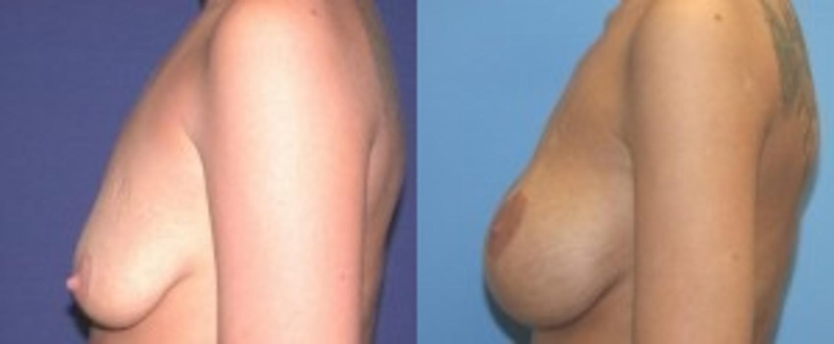 Before & After Breast Augmentation Case 14 Left Side View in Ann Arbor, MI