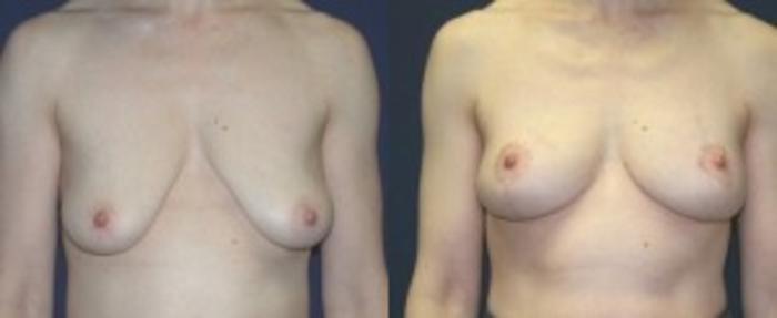 Before & After Breast Augmentation Case 15 Front View in Ann Arbor, MI