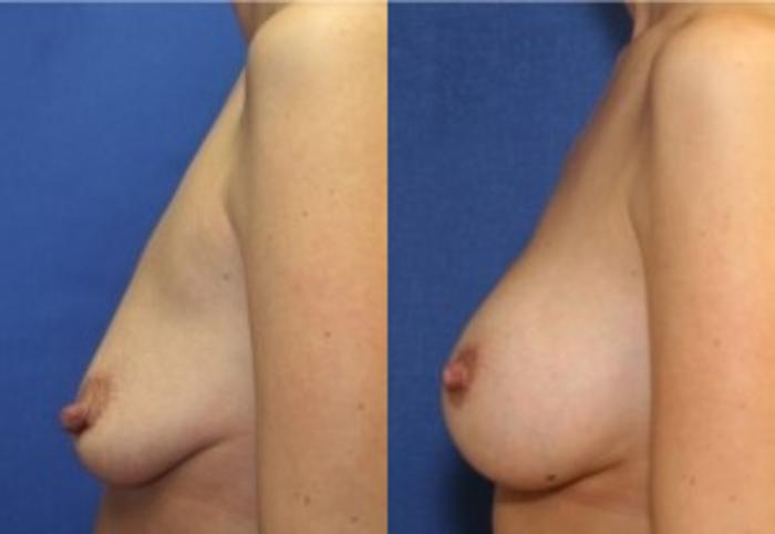 Before & After Breast Augmentation Case 16 Left Side View in Ann Arbor, MI