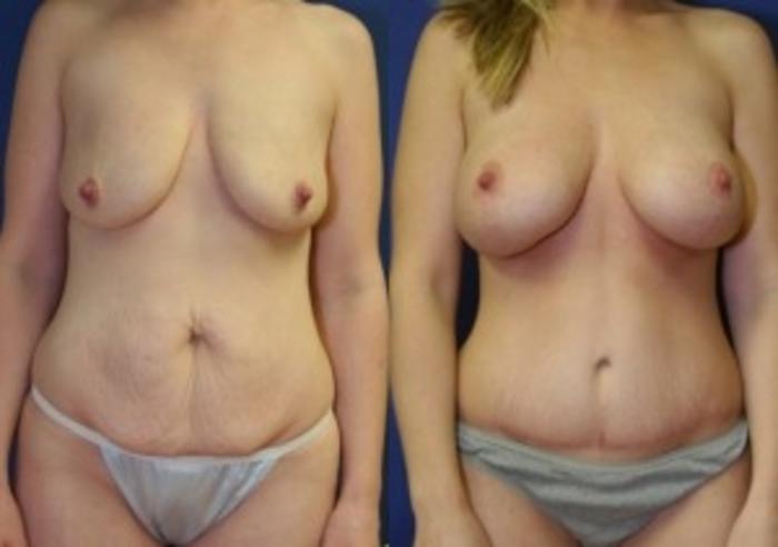 Before & After Breast Augmentation Case 17 Front View in Ann Arbor, MI