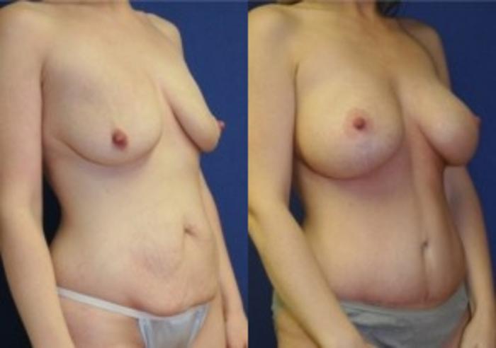 Before & After Breast Augmentation Case 17 Right Oblique View in Ann Arbor, MI