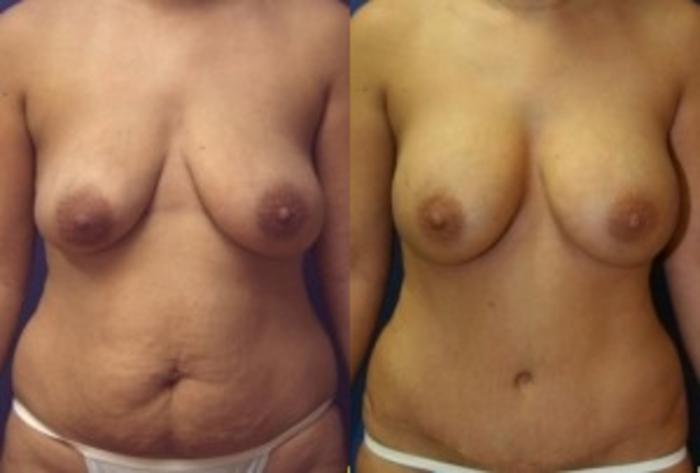 Before & After Breast Augmentation Case 18 Front View in Ypsilanti, MI