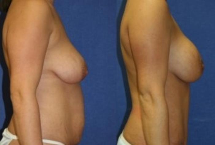Before & After Breast Augmentation Case 18 Right Side View in Ypsilanti, MI