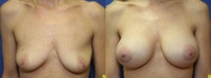 Before & After Breast Augmentation Case 19 Front View in Ann Arbor, MI