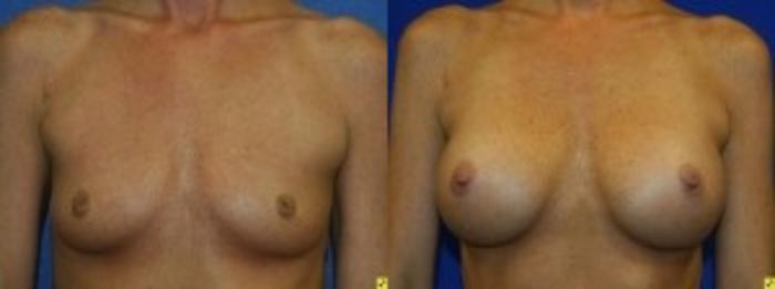 Before & After Breast Augmentation Case 20 Front View in Ypsilanti, MI