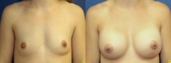 Before & After Breast Augmentation Case 21 Front View in Ypsilanti, MI