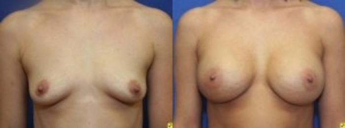 Before & After Breast Augmentation Case 22 Front View in Ann Arbor, MI
