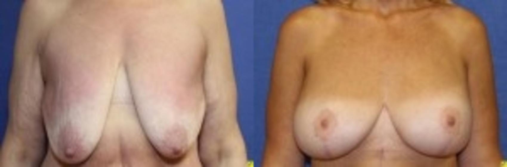 Before & After Breast Augmentation Case 23 Front View in Ann Arbor, MI