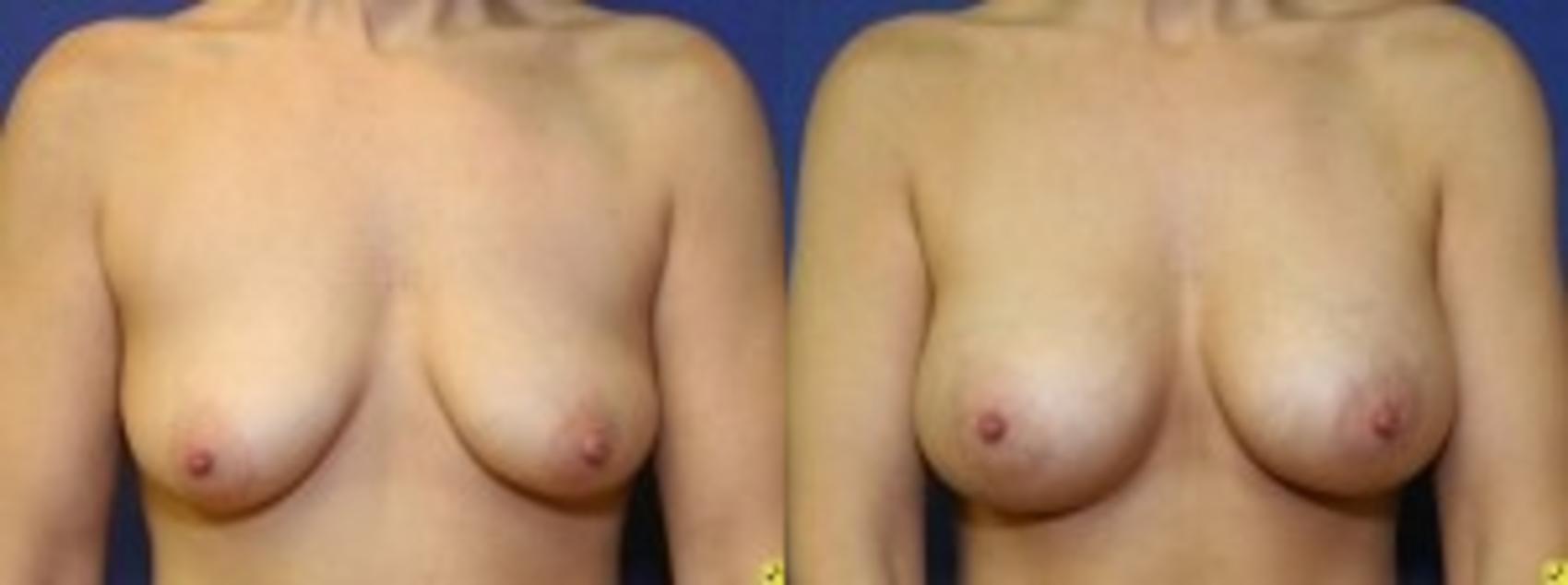 Before & After Breast Augmentation Case 24 Front View in Ann Arbor, MI