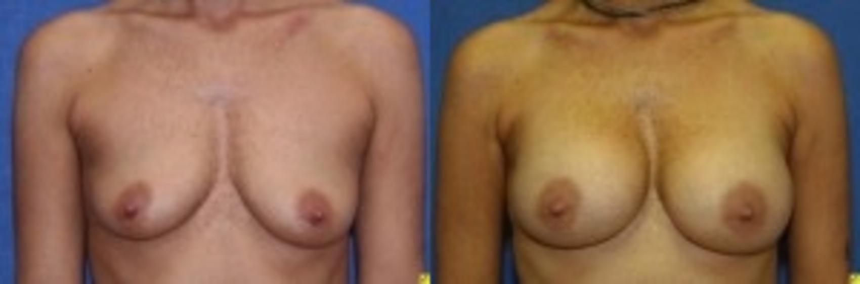 Before & After Breast Augmentation Case 25 Front View in Ann Arbor, MI