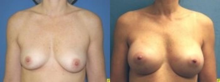 Before & After Breast Augmentation Case 26 Front View in Ann Arbor, MI