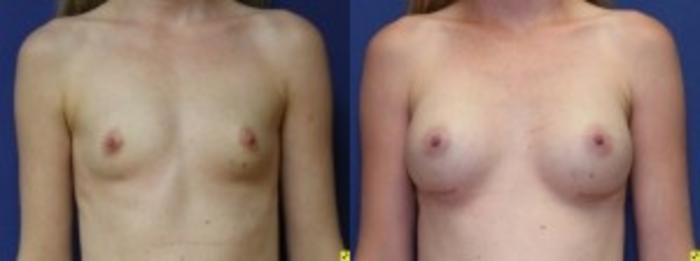 Before & After Breast Augmentation Case 27 Front View in Ypsilanti, MI