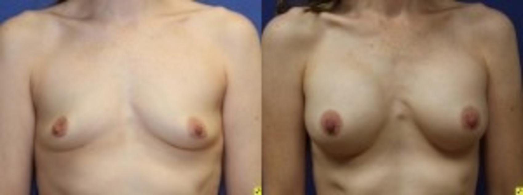 Before & After Breast Augmentation Case 28 Front View in Ann Arbor, MI