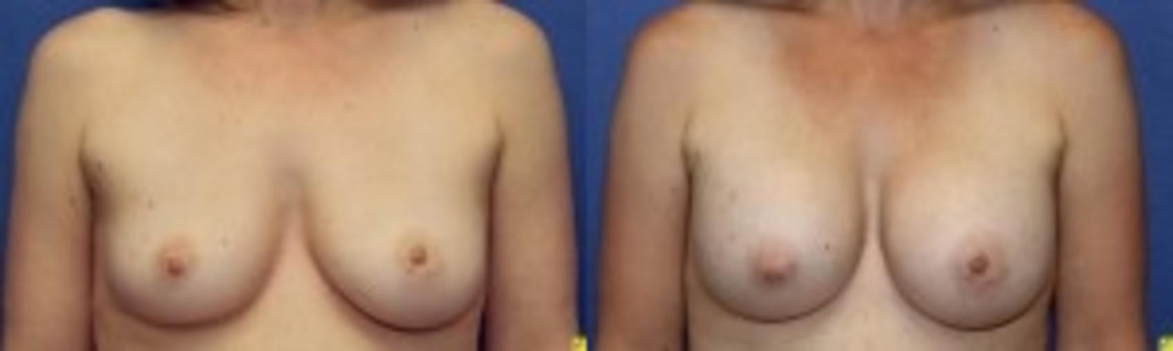 Before & After Breast Augmentation Case 29 Front View in Ypsilanti, MI