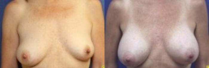 Before & After Breast Augmentation Case 30 Front View in Ypsilanti, MI