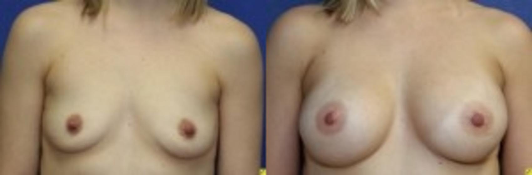 Before & After Breast Augmentation Case 31 Front View in Ann Arbor, MI