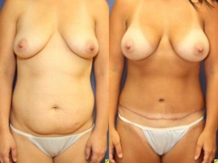 Before & After Breast Augmentation Case 32 Front View in Ann Arbor, MI