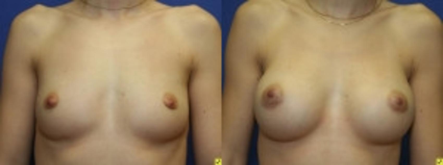 Before & After Breast Augmentation Case 33 Front View in Ann Arbor, MI