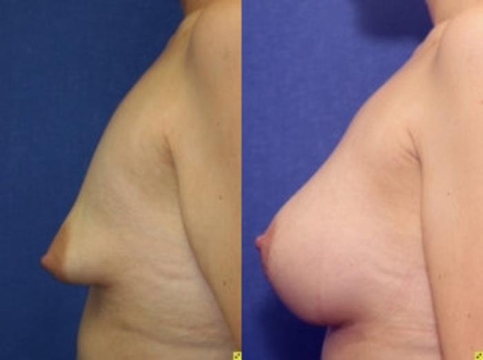 Before & After Breast Augmentation Case 33 Left Side View in Ann Arbor, MI