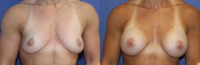 Before & After Breast Augmentation Case 34 Front View in Ann Arbor, MI