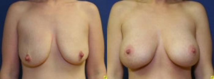 Before & After Breast Augmentation Case 35 Front View in Ann Arbor, MI