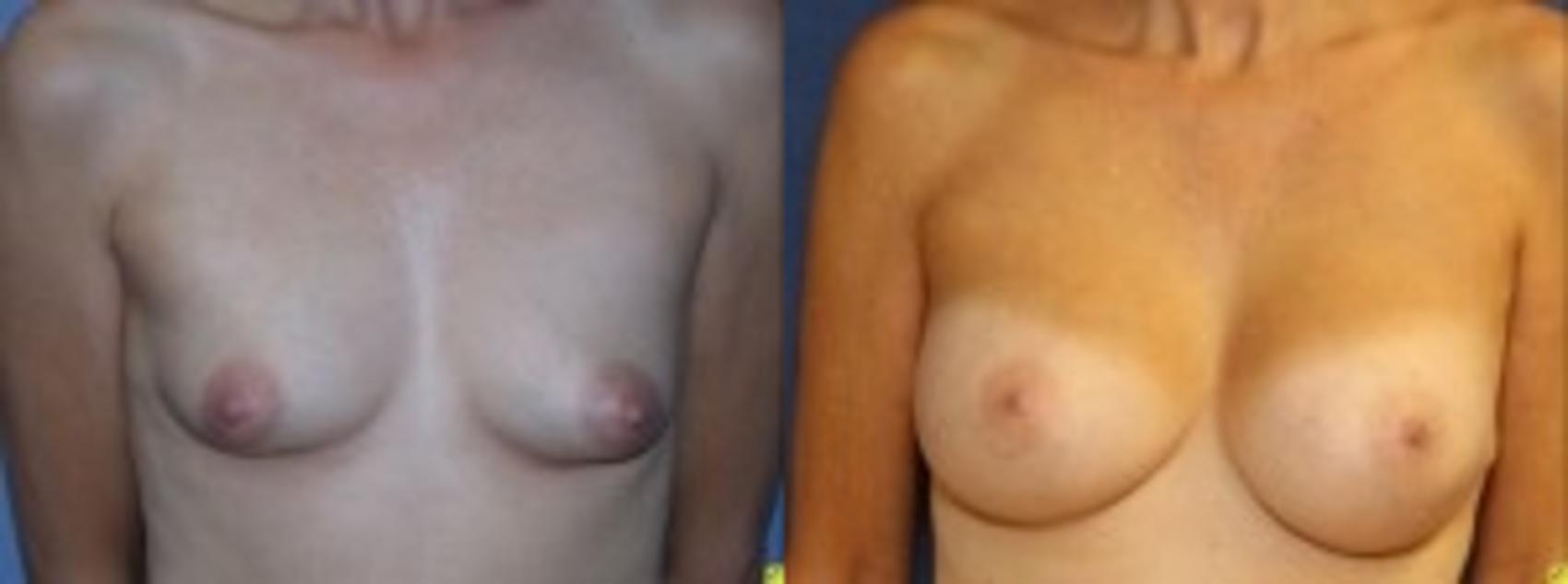 Before & After Breast Augmentation Case 36 Front View in Ann Arbor, MI
