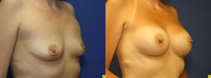 Before & After Breast Augmentation Case 37 Right Oblique View in Ann Arbor, MI