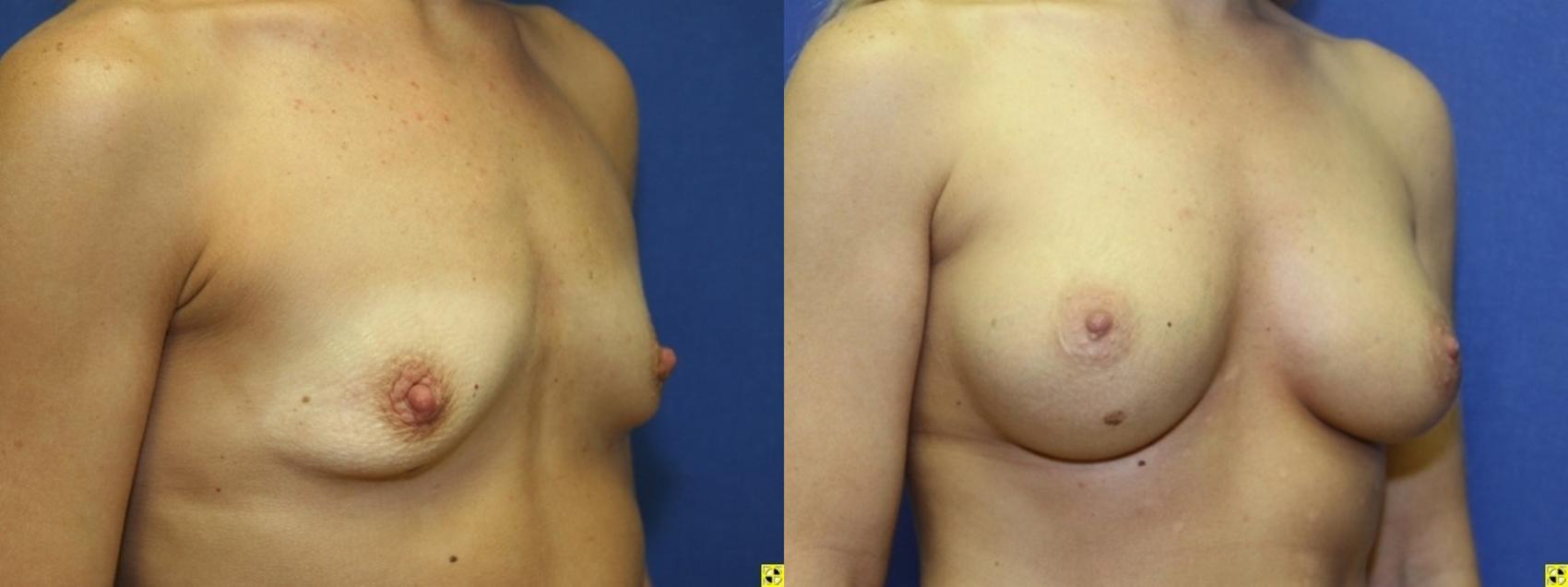 Before & After Breast Augmentation Case 38 Right Oblique View in Ann Arbor, MI