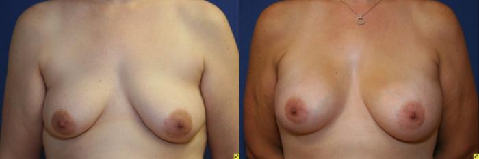 Before & After Breast Augmentation Case 39 Front View in Ann Arbor, MI