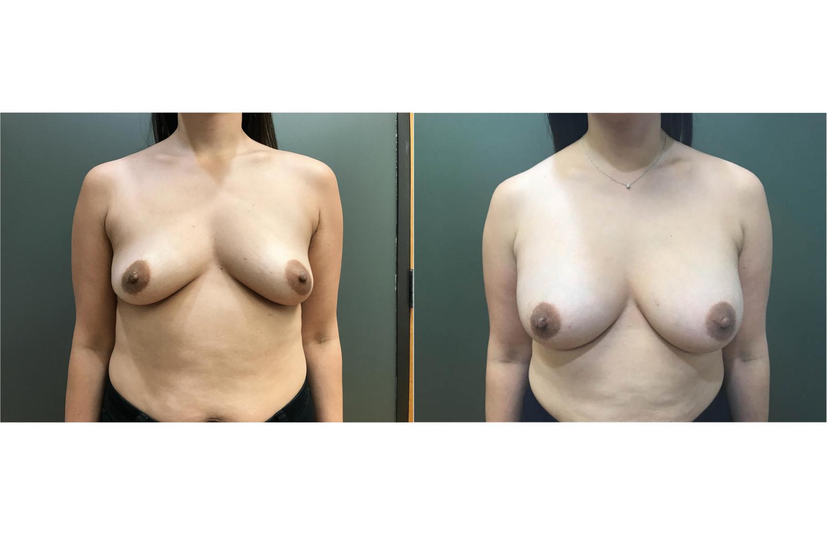 Before & After Breast Augmentation Case 393 Front View in Ann Arbor, MI
