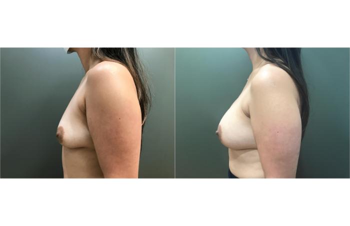 Before & After Breast Augmentation Case 393 Left Side View in Ann Arbor, MI