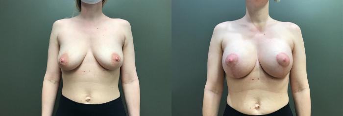 Before & After Breast Augmentation Case 399 Front View in Ann Arbor, MI