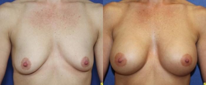Before & After Breast Augmentation Case 40 Front View in Ann Arbor, MI