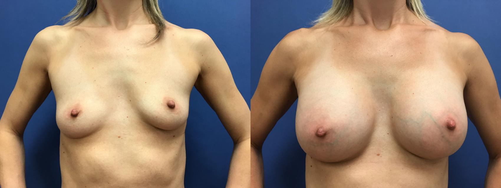 Before & After Breast Augmentation Case 41 Front View in Ypsilanti, MI