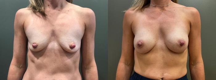 Before & After Breast Augmentation Case 410 Front View in Ann Arbor, MI