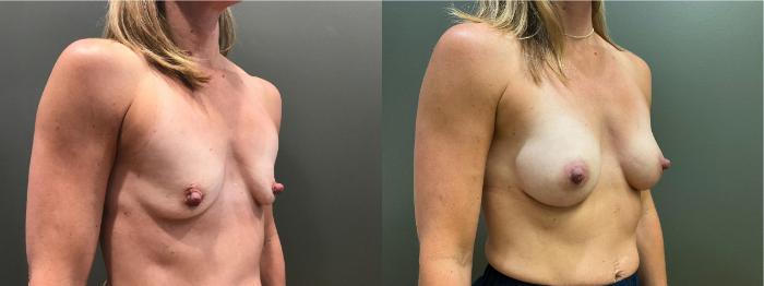 Before & After Breast Augmentation Case 410 Right Side View in Ann Arbor, MI