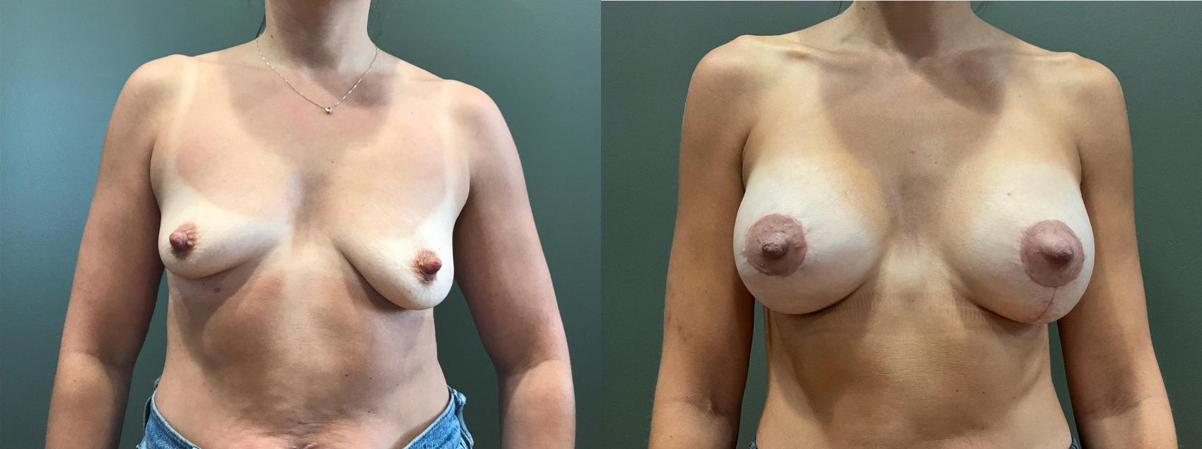 Before & After Breast Augmentation Case 411 Front View in Ann Arbor, MI