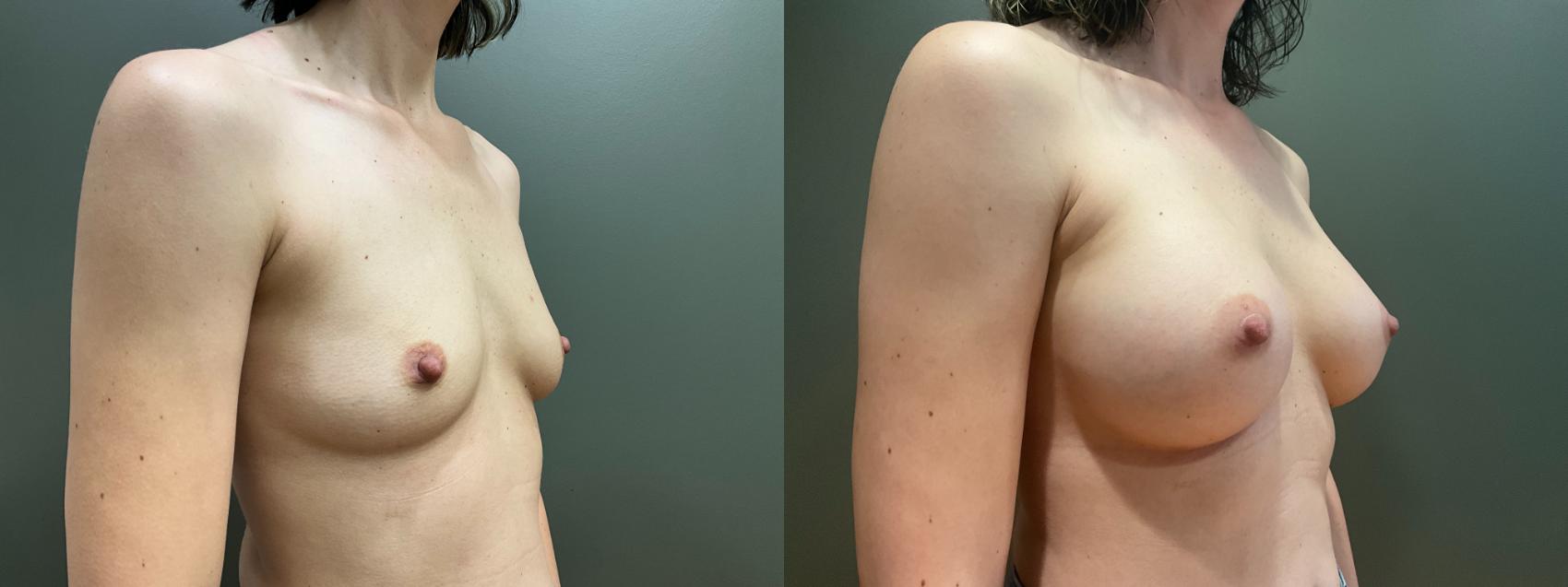 Before & After Breast Augmentation Case 419 Right Oblique View in Ann Arbor, MI