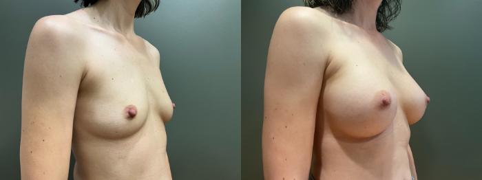 Before & After Breast Augmentation Case 419 Right Oblique View in Ann Arbor, MI