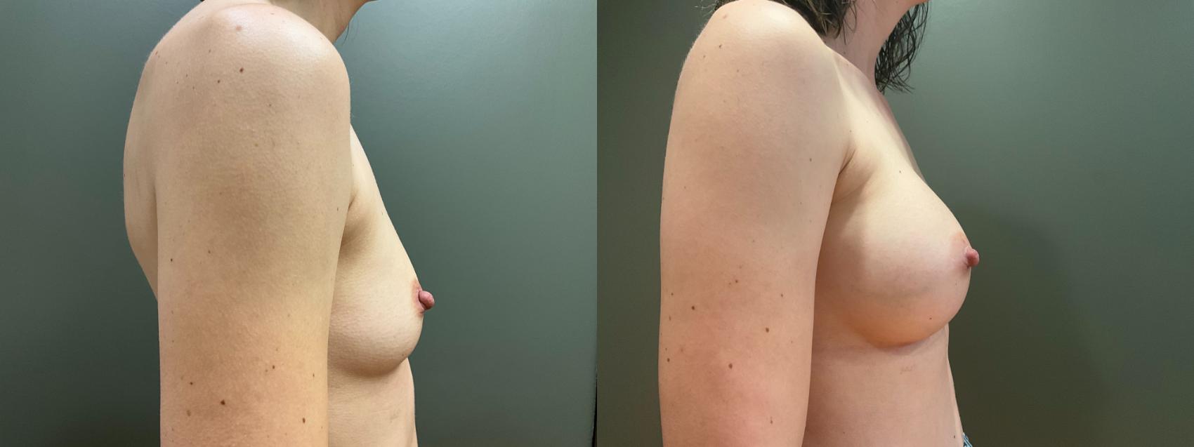 Before & After Breast Augmentation Case 419 Right Side View in Ann Arbor, MI