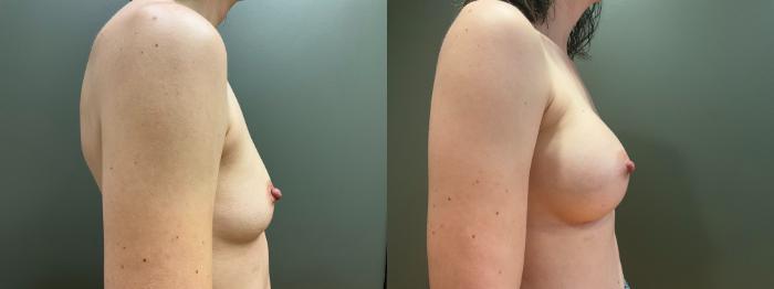 Before & After Breast Augmentation Case 419 Right Side View in Ann Arbor, MI