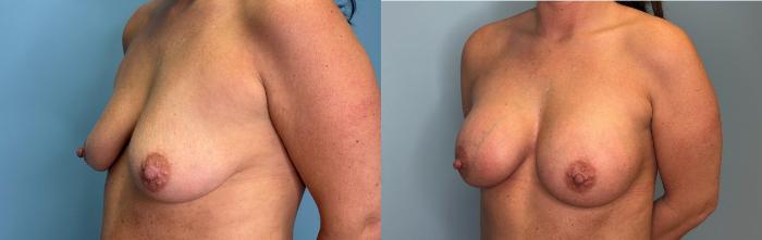 Before & After Breast Augmentation Case 427 Left Oblique View in Ann Arbor, MI