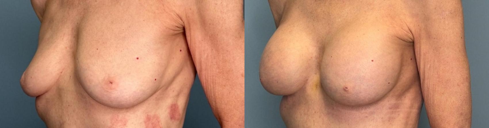 Before & After Breast Augmentation Case 433 Left Oblique View in Ann Arbor, MI