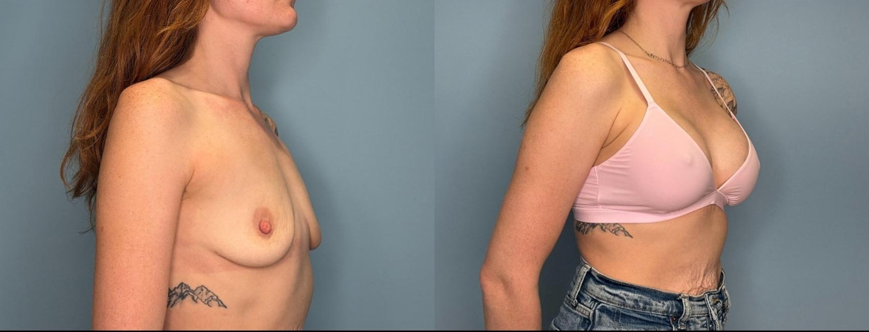 Before & After Breast Augmentation Case 437 Results with Bra View in Ann Arbor, MI
