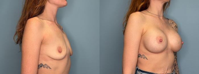 Before & After Breast Augmentation Case 437 Right Oblique View in Ann Arbor, MI